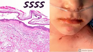 Staphylococcal scalded skin syndrome SSSS 5Minute Pathology Pearls [upl. by Daj]