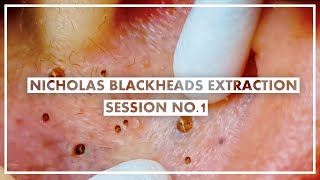 Nicholas 1st Session  Ear Forehead and Cheeks Blackheads Extraction [upl. by Lenzi603]