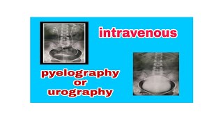 Intravenous Pyelography  Urography IVP  IVU [upl. by Constantino]