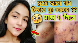 ব্রণের কালো দাগ কিভাবে দূর করবেন মাত্র ৭ দিনে  How To Remove Pimple MarkAcne mark In Just 7 Days [upl. by Muns527]