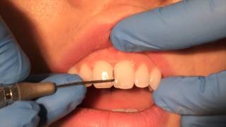 Periodontal Probing [upl. by Nitneuq99]