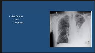 Thoracic Empyema case discussion [upl. by Aniri583]