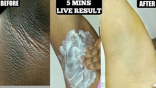 IN 5 MINUTES LIGHTEN DARK UNDERARMS NATURALLY AND PERMANENTLY [upl. by Gina]