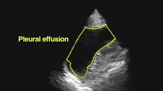 NEJM US guided thoracentesis [upl. by Novyaj]