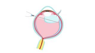 Retinal Detachment Treatment—Pars Plana Vitrectomy [upl. by Sebbie]