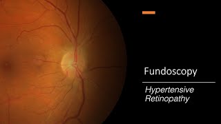 Demystifying Retinal Diseases [upl. by Eerized]