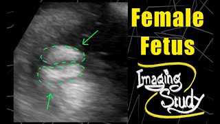 Female Fetus  Its a Girl  Ultrasound  Case 101 [upl. by Ilrahs]