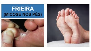 MICOSE NOS PÉS Frieira  Como combater Por Luiz Gameiro dermatologista [upl. by Marcel536]