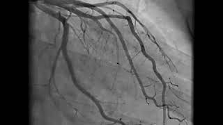 Coronary Angiography  NEJM [upl. by Flora746]