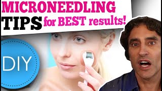 MICRONEEDLING DIY at HOME  What You Need to Know [upl. by Ahseinat]