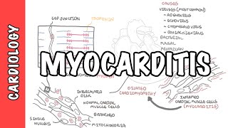 Myocarditis  causes pathophysiology investigation and treatment [upl. by Cleo]