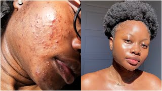 my skincare routine for acne amp scars finally [upl. by Stulin]