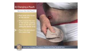 What is an Ileostomy [upl. by Alcine775]