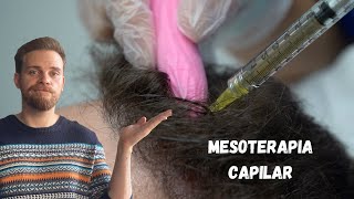 ¿FUNCIONA LA MESOTERAPIA CAPILAR [upl. by Aroled]