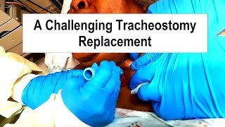 A Challenging Tracheostomy Replacement [upl. by Denman]