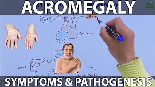 Acromegaly  Symptoms and Complications [upl. by Ahsyat]