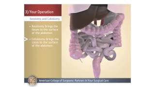 Exploratory Laparotomy  3D Medical Animation  Part  2  Films Blueray [upl. by Larimor]