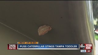 Puss caterpillar stings Tampa toddler [upl. by Aliuqaj]