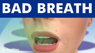 Halitosis Bad Breath  Causes and Treatment [upl. by Anitsej]