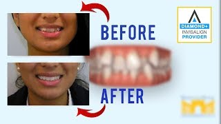 Invisalign Before and After Crowded Teeth [upl. by Aube]