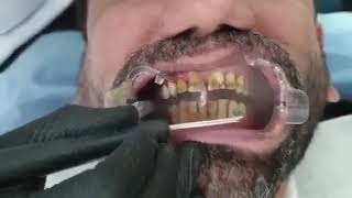 Teeth stain removal with Airflow [upl. by Skyler]