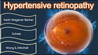 Classification of Diabetic Retinopathy [upl. by Nevs]