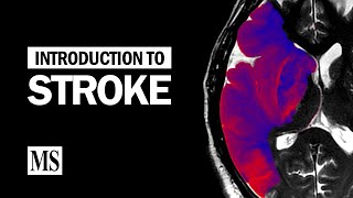 Stroke Education  Dysphagia [upl. by Bethena385]