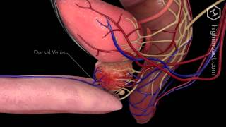 Open Prostatectomy [upl. by Emelita]