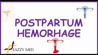 Postpartum Hemorrhage PPH causesrisk factorsprevention and treatment [upl. by Sailesh944]