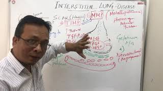 Interstitial lung diseasepathophysiology [upl. by Eiluj]