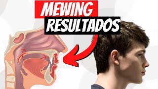 MEWING Resultados  ¿CUÁNTO TARDA [upl. by Arimas]