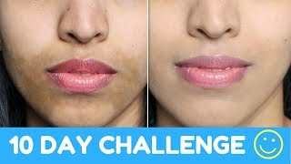 How To Get Even Skin Tone Naturally Powerful Home Remedy Hyper Pigmentation [upl. by Annerol65]