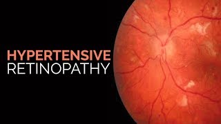 Diabetic Retinopathy Lecture and Diabetic Retinopathy Treatment  Diabetic Eye Exam [upl. by Kruger]