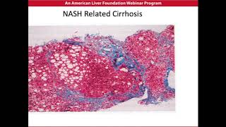 NASH Disease Overview [upl. by Matty866]