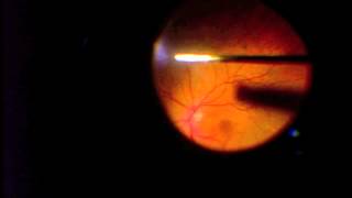 Vitrectomy for Vitreous Opacification FOV [upl. by Assyle]