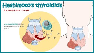 Hashimotos thyroiditis  Autoimmune diseases [upl. by Esiled999]