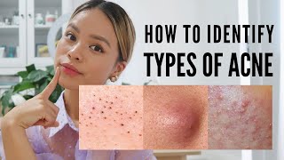 How to treat EVERY type of acne With Pictures [upl. by Ahtinak93]