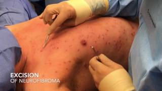 Dr Pimple Popper  Removing Five 35 Year Old Cysts [upl. by Powers]