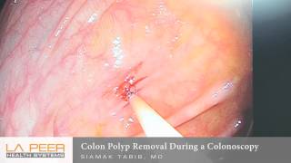 Colon Polyp Removal During Colonoscopy  Los Angeles La Peer Surgery Center [upl. by Aztiram403]