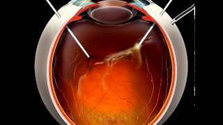 Vitrectomy animation [upl. by Latton724]