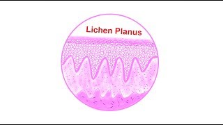 Lichen planus Histopathological features  Lets draw [upl. by Sholeen230]