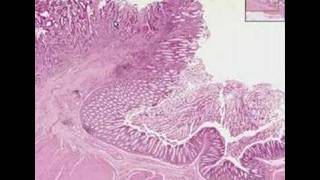 Histopathology ColonAdenocarcinoma [upl. by Nylarat]