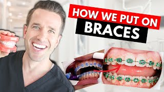 How Braces are Put On  Part IV Dr Nate [upl. by Pettiford]