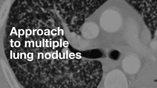 Algorithmic Approach to Multiple Lung Nodules [upl. by Dniren]