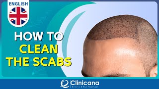 How to clean the scabs after 11 days from the hair transplant operation [upl. by Aitnecserc]