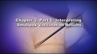 Chapter 1 Smallpox Vaccination with ACAM2000 Introduction [upl. by Johppah]