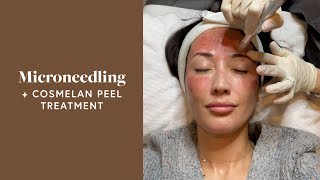 Microneedling Treatment amp Cosmelan Peel For My Melasma  Susan Yara [upl. by Berstine]