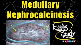 Medullary Nephrocalcinosis  Ultrasound  Case 128 [upl. by Creamer]