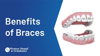 What are the Real Benefits of Braces  Western Dental [upl. by Cristen]