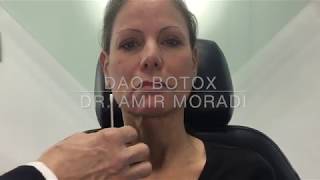 Botox in Depressor Anguli Oris DAO Muscle Dr Amir Moradi San Diego California [upl. by Noxaj992]